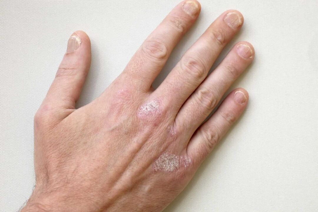 psoriáza na rukách muža liečba krémom Keramin