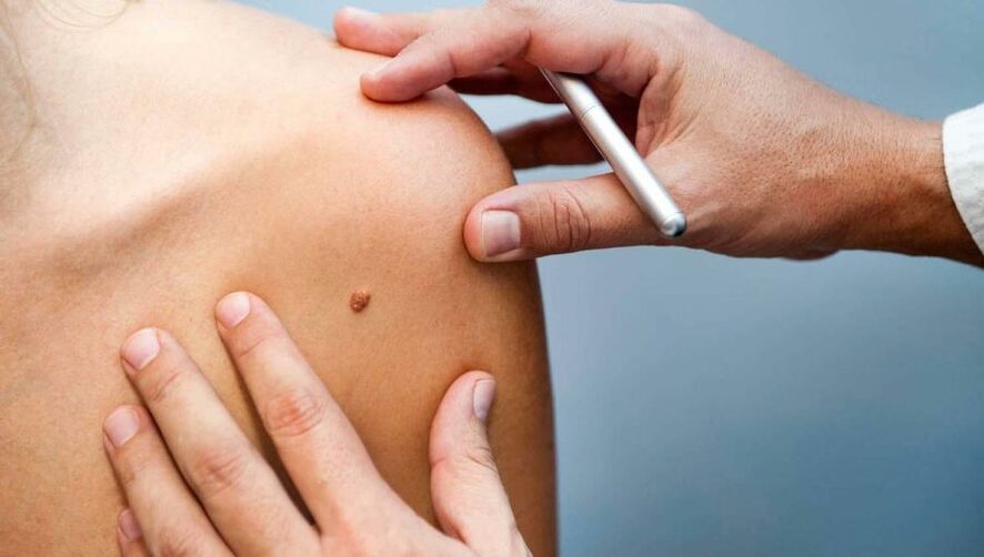 Dermatológ vyšetrujúci pacienta s papilómom