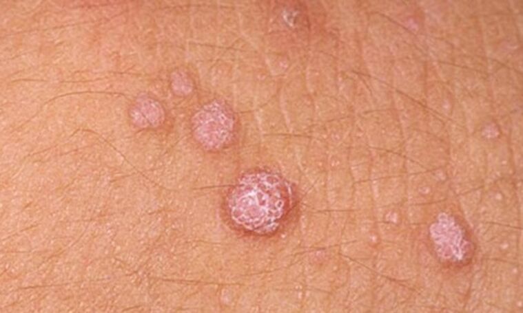 HPV vedie k vzniku kožných papilómov