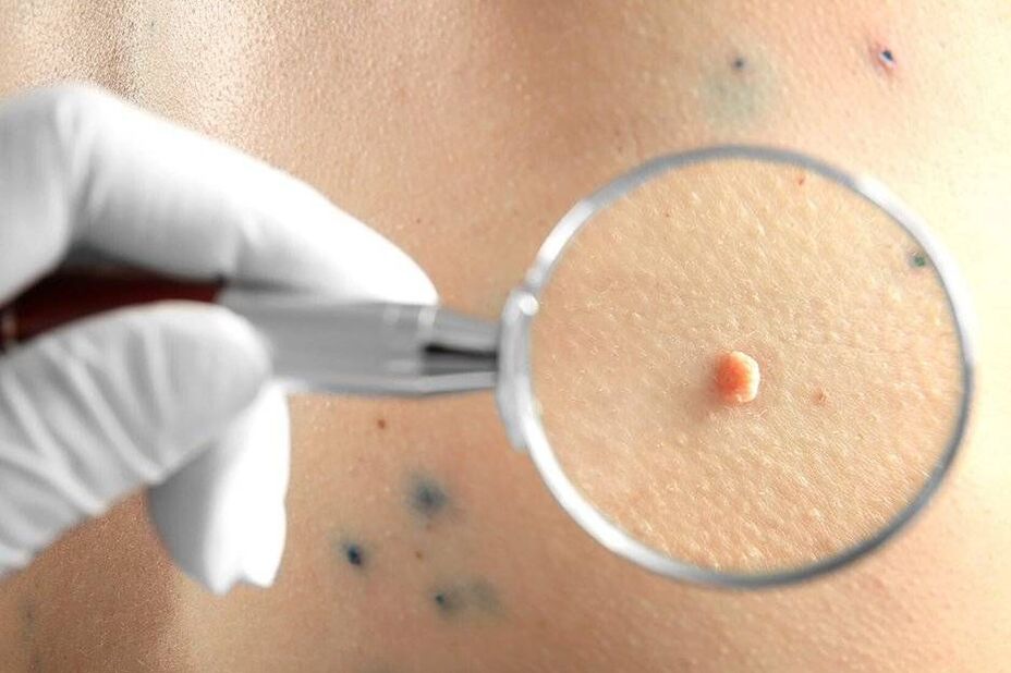 Liečba HPV