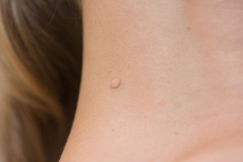 príznaky HPV